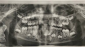 Foto Rontgen Gigi Anak yang Berusia 6 Tahun Foto: Boredpanda