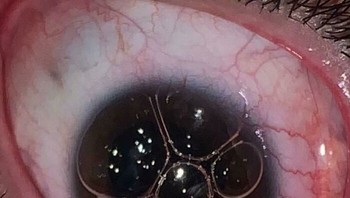 Gelembung Gas di Mata Foto: Boredpanda