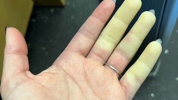 Sindrom Raynaud adalah kondisi medis yang memengaruhi aliran darah ke bagian tubuh tertentu — biasanya jari tangan, jari kaki, telinga, atau hidung — sebagai respons terhadap udara dingin atau stres Foto: Boredpanda