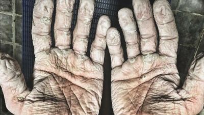 Asli! Ini Foto Kondisi Tubuh Manusia yang Bikin Merinding