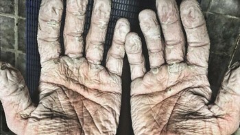 Tangan Pendayung Olimpiade Setelah Mendayung 1000 Km Foto: Boredpanda