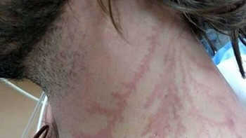 Tersambar Petir Dapat Meninggalkan Bekas Seperti Tato atau Bekas Luka yang Dikenal Sebagai Figur Lichtenberg Foto: Boredpanda