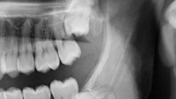 Gegara arah pertumbuhan gigi yang tidak tepat membuat rasa sakit luar biasa. Foto: Boredpanda