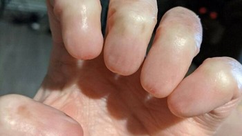 Kondisi Anonychia adalah hilangnya sebagian atau seluruh kuku pada jari tangan atau kaki. Foto: Boredpanda