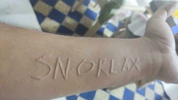 Kondisi Kulit Yang Disebut Dermatographia, Yang Sebabnya Jika Seseorang Menggaruk Kulit dengan Ringan Akan Muncul Garis Merah Menonjol Di Tempat Yang Digaruk Foto: Boredpanda