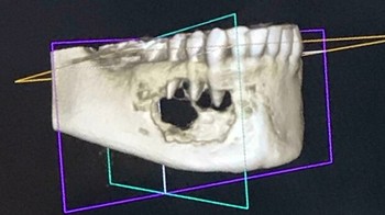 Foto scan CT memperlihatkan kondisi rahang yang dimakan tumor. Foto: Boredpanda