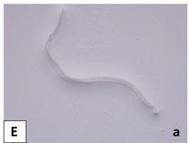 Penampakan 4 Cacing Ngumpet di Kelopak Mata Wanita, Awalnya Ngeluh Gatal