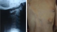Benjolan-benjolan yang terasa nyeri muncul di punggung akibat massa keras dan kekakuan pada bahu, leher, serta pinggul kiri. Kondisi ini membuatnya juga sulit berjalan atau jongkok secara normal. (Foto: Journal of Medical Case Reports)