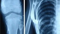 Pasien tidak sembuh total, tapi menjalani perawatan konservatif untuk membantu mengurangi perburukan gejala. Pasien sempat menjalani operasi pengangkatan tulang yang tumbuh secara tak normal di pinggul kiri, tapi justru terjadi pertumbuhan tulang yang lebih parah. (Foto: Journal of Medical Case Reports)
