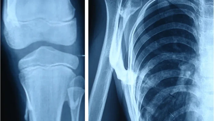 Sindrom manusia batu.