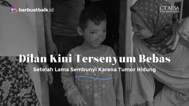 Semakin Riang, Semua Operasi Tumor Hidung Dilan Sukses