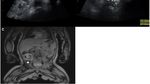 Foto Fenomena Fetus in Fetu, Ketika Hidup dengan Janin Parasit di Tubuhnya