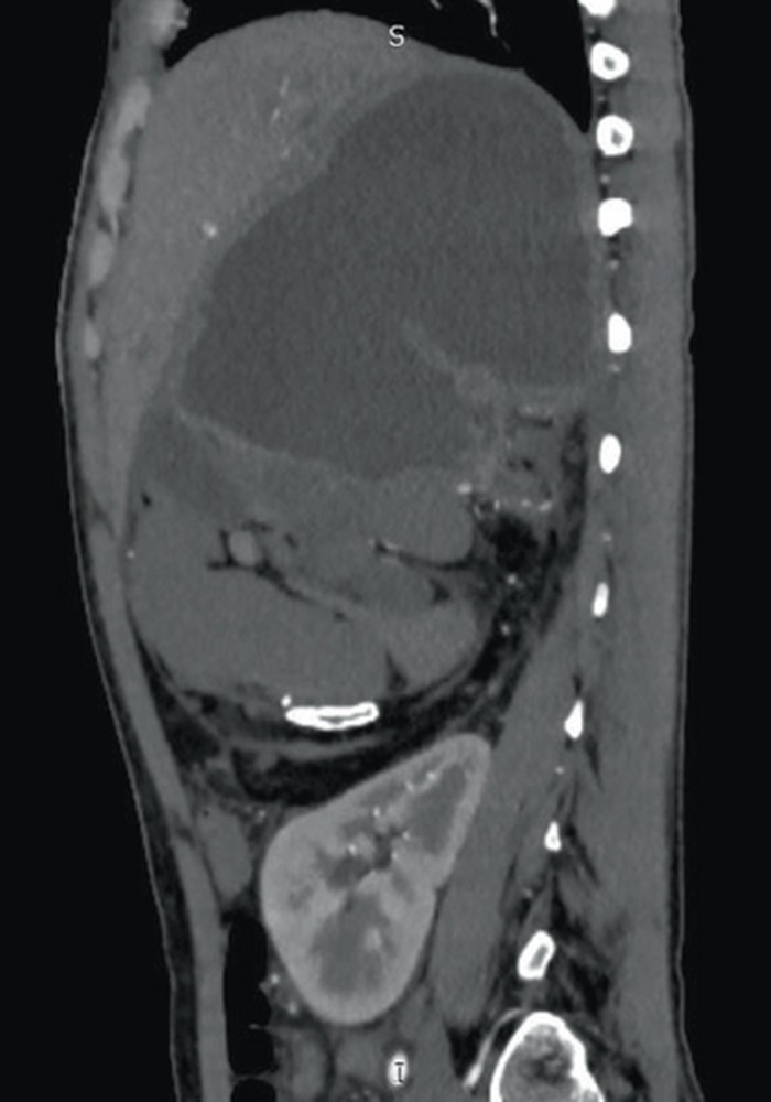 Seorang wanita 21 tahun 'mengandung' jaringan lunak janin selama 6-7 tahun.