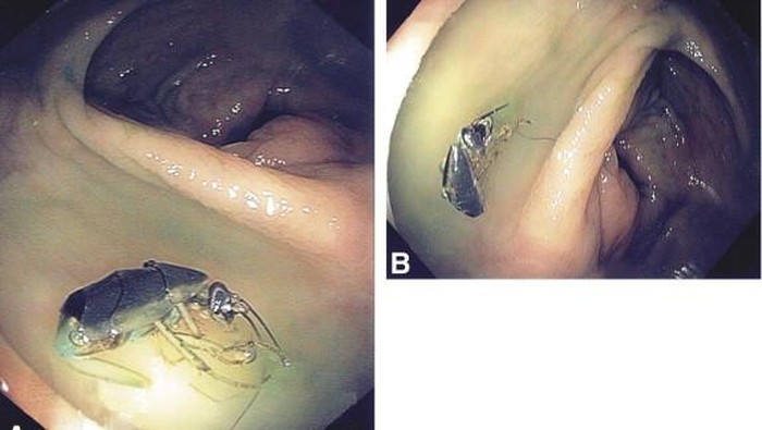 kecoa di usus pasien