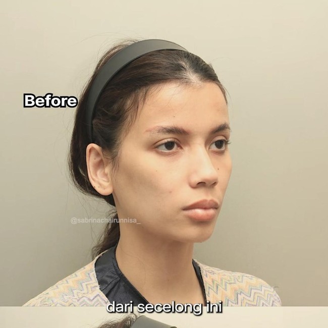 7 Foto Before-After Sabrina Istri Deddy Corbuzier Jalani Fat Graft