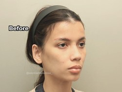 7 Foto Before-After Sabrina Istri Deddy Corbuzier Jalani Fat Graft