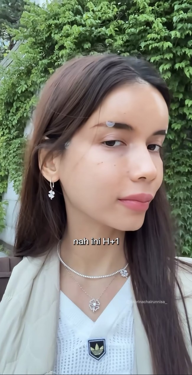 Sehari setelah tindakan wajahnya pun terlihat normal tanpa lebam, hanya ada beberapa bekas suntikan dan plester yang masih menempel. best decision ever sih fat graft ke mukaku yang dari super tirus dan cekung jadi lebih ke isi, lebih fresh tanpa takut geser2 kaya filler dan hasilnya lebih NATURAL. Karena ini pake our own fat. Dan fat yg di ambil dan di suntik tu ga banyak.. cuman 20-30 cc jg max yang udah ready siap di injeksi ke muka, tulisnya di keterangan unggahan. Foto: Instagram/@sabrinachairunnisa_