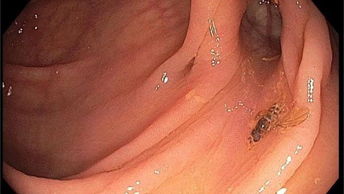 serangga di tubuh pasien