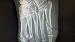 Irwansyah Patah Kaki saat Asyik Main Bareng Anak
