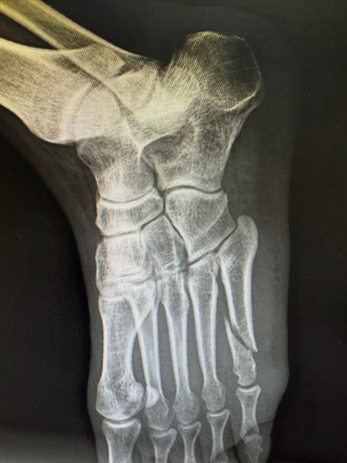 Irwansyah Irwansyah patah kaki.