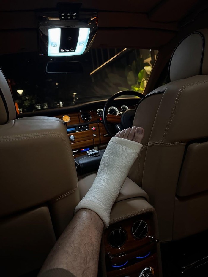 Irwansyah Irwansyah patah kaki.