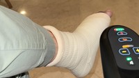 Bagian kaki Irwansyah yang patah menggunakan gips. Foto: dok. Instagram Irwansyah