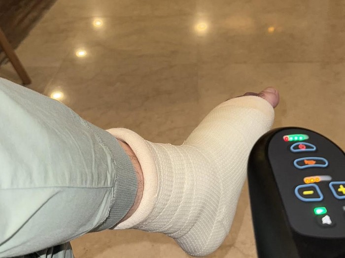 Irwansyah Irwansyah patah kaki.