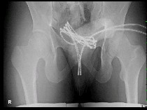 Malu Banget! Pemuda Ini Masukkan Kabel USB ke Alat Kelaminnya, Berujung Operasi