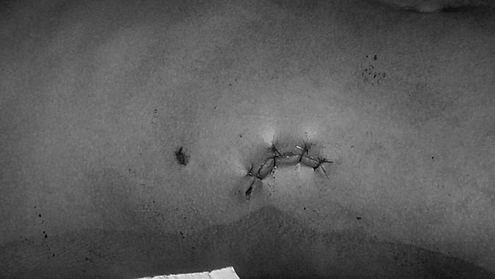 Pisau nyangkut di dalam perut pria Nepal