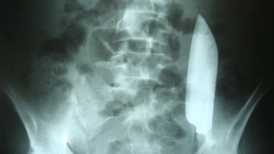 Momen Menegangkan Dokter Cabut Pisau Berukuran 15 Cm dari Perut Pria Ini