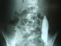 Momen Menegangkan Dokter Cabut Pisau Berukuran 15 Cm dari Perut Pria Ini