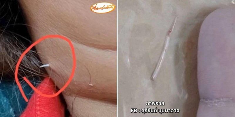 10 Benda Nyangkut di Tenggorokan hingga Tertelan