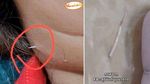 10 Benda Nyangkut di Tenggorokan hingga Tertelan, Ada Sikat Gigi di Lambung!