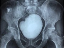 Penampakan Batu Kandung Kemih Seberat 900 gram, Ketahuan usai Ngeluh Pipis Berdarah