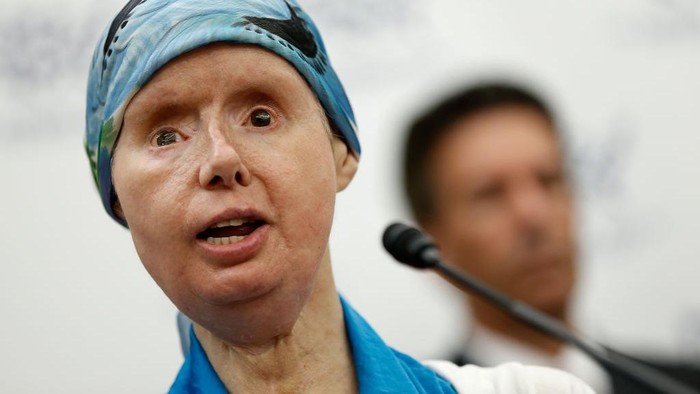 (Boston,  MA,  01/28/14)Charla Nash, who was blinded, lost both hands and underwent a face transplant after being mauled by a neighbor's chimp in Connecticut in 2009, talks about her life now during an interview at Brigham and Women's Hospital onTuesday,  January 28,  2014.  Staff Photo by Nancy Lane  (Photo by Nancy Lane/MediaNews Group/Boston Herald via Getty Images)