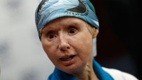 Charla sekarang tinggal di fasilitas perawatan assisted living untuk terapi bicara dan rehabilitasi lainnya. Ia berharap nantinya bisa kembali makan enak dengan lebih mudah. (Foto: MediaNews Group via Getty Images/MediaNews Group/Boston Herald vi)