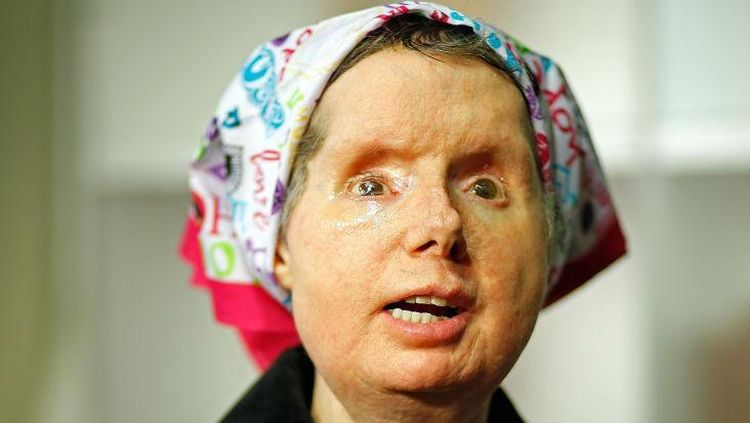 Foto Wanita Jalani Transplantasi Wajah, Mukanya Hancur Parah Diserang Simpanse