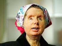 Foto Wanita Jalani Transplantasi Wajah, Mukanya Hancur Parah Diserang Simpanse