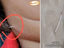 Wanita Ini Tersedak Duri Ikan Sampai Menembus Kulit Lehernya