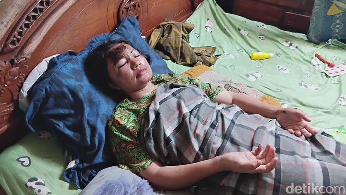 Yuniawati (42) bersama anaknya dijambret di Palembang, Sumsel hingga jatuh dan terluka parah.