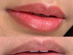 Sulam Bibir untuk Atasi Bibir Gelap Tanpa Lipstik, Ini yang Harus Diperhatikan