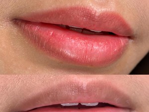 Sulam Bibir untuk Atasi Bibir Gelap Tanpa Lipstik, Ini yang Harus Diperhatikan