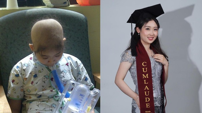 Kisah Inspiratif Michelle, Penyintas Kanker Darah yang Kini Jadi Psikolog