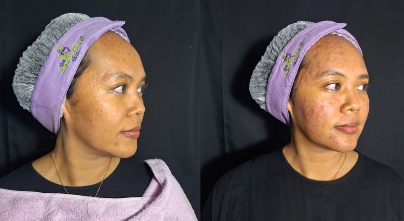 Wajah saya sebelum perawatan (kiri) versus setelah perawatan (kanan) Skin Booster DNA Salmon dan Pico Laser.
