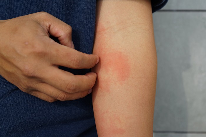 A close-up of bad psoriasis on a persons forearm