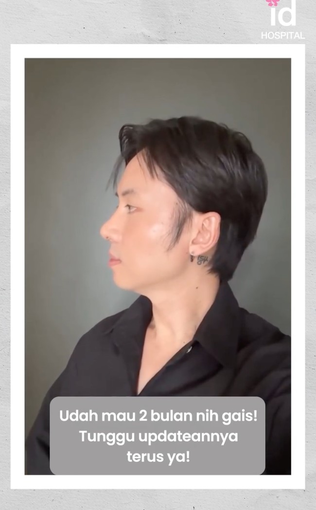 Dilihat dari samping bagian hidung Rafael kini jadi jauh lebih mancung dan ramping. Foto tersebut diambil setelah hampir 2 bulan pasca operasi, sehingga bengkak di wajahnya sudah hilang. Foto: Instagram/@rafaell_16
