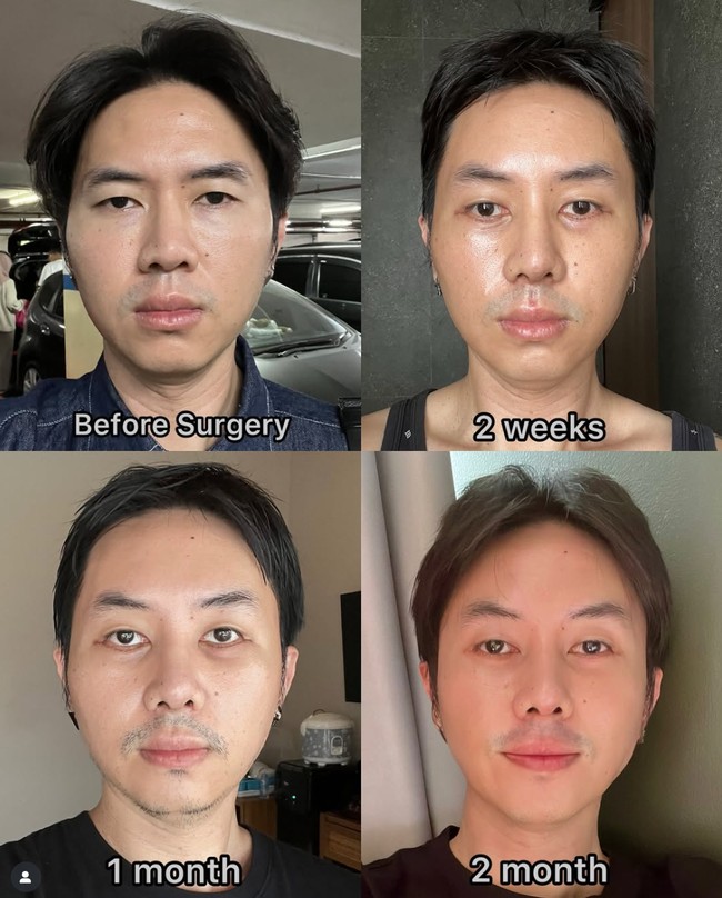 Potret transformasi wajah Rafael dari sebelum hingga 2 bulan setelah menjalani operasi plastik. Di lihat dari depan wajahnya memang tak banyak berubah. Foto: Instagram/@rafaell_16