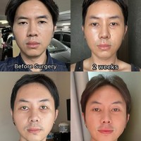Potret transformasi wajah Rafael dari sebelum hingga 2 bulan setelah menjalani operasi plastik. Di lihat dari depan wajahnya memang tak banyak berubah. Foto: Instagram/@rafaell_16