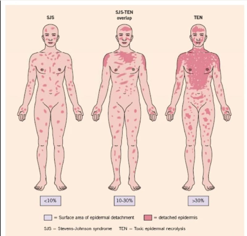 Representasi gambar SJS yang menunjukkan permukaan pengelupasan epidermis (Diadaptasi dari Gambar 21.9 Bolognia dan Bastuji-Garin S. et al. Arch Derm 129: 92, 1993)