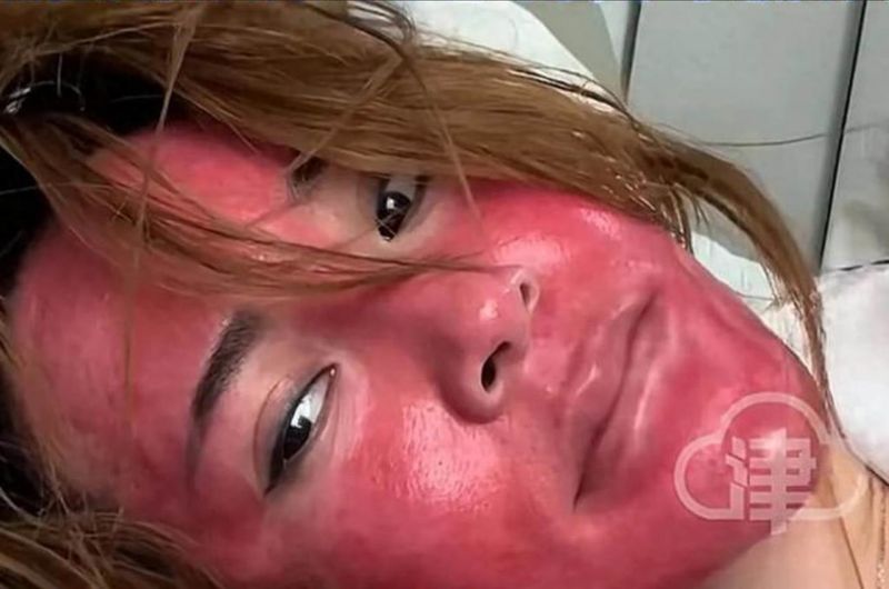 Wajah wanita ini iritasi parah karena tidak pernah hapus makeup selama 22 tahun.